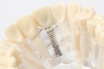 最新の歯科用CTを導入